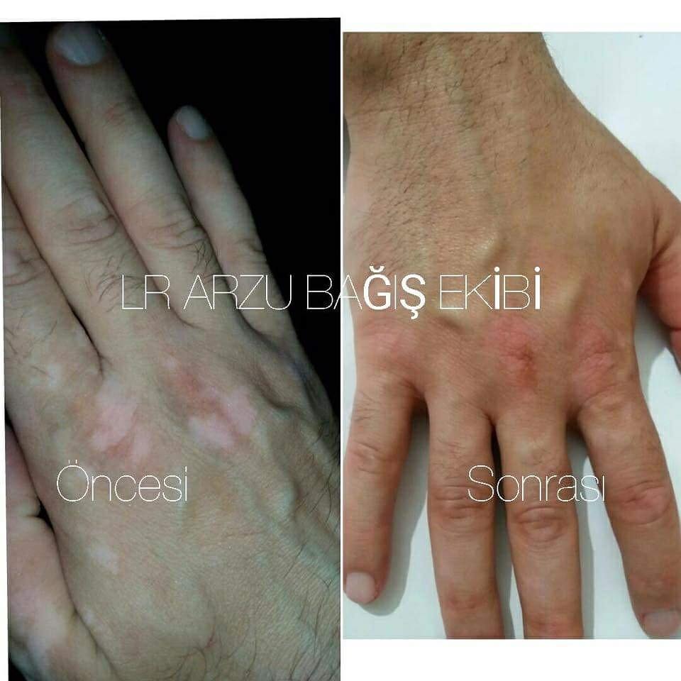 vitiligo LR urunleri dermaintense acil yardim spreyi